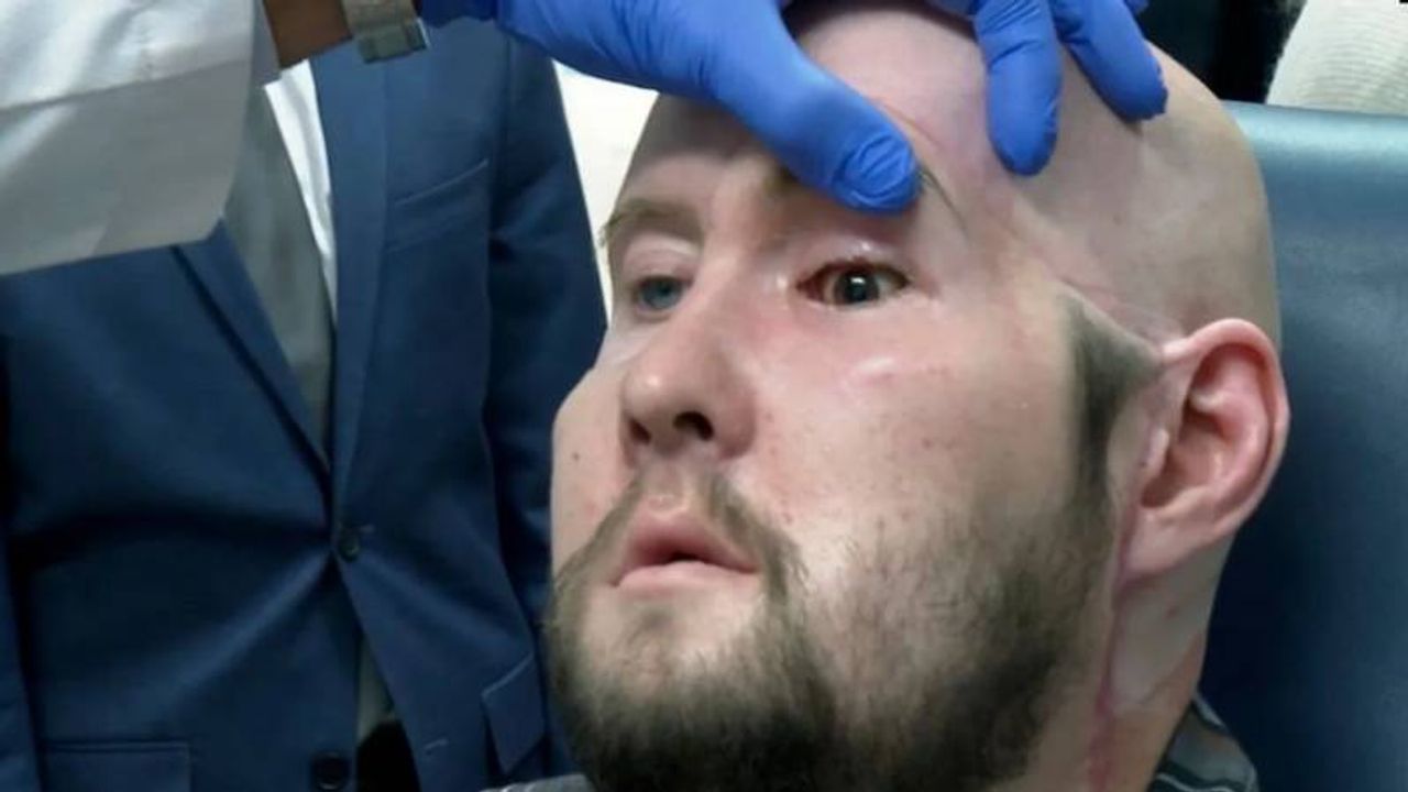Dünyanın ilk göz nakli ameliyatı yapıldı