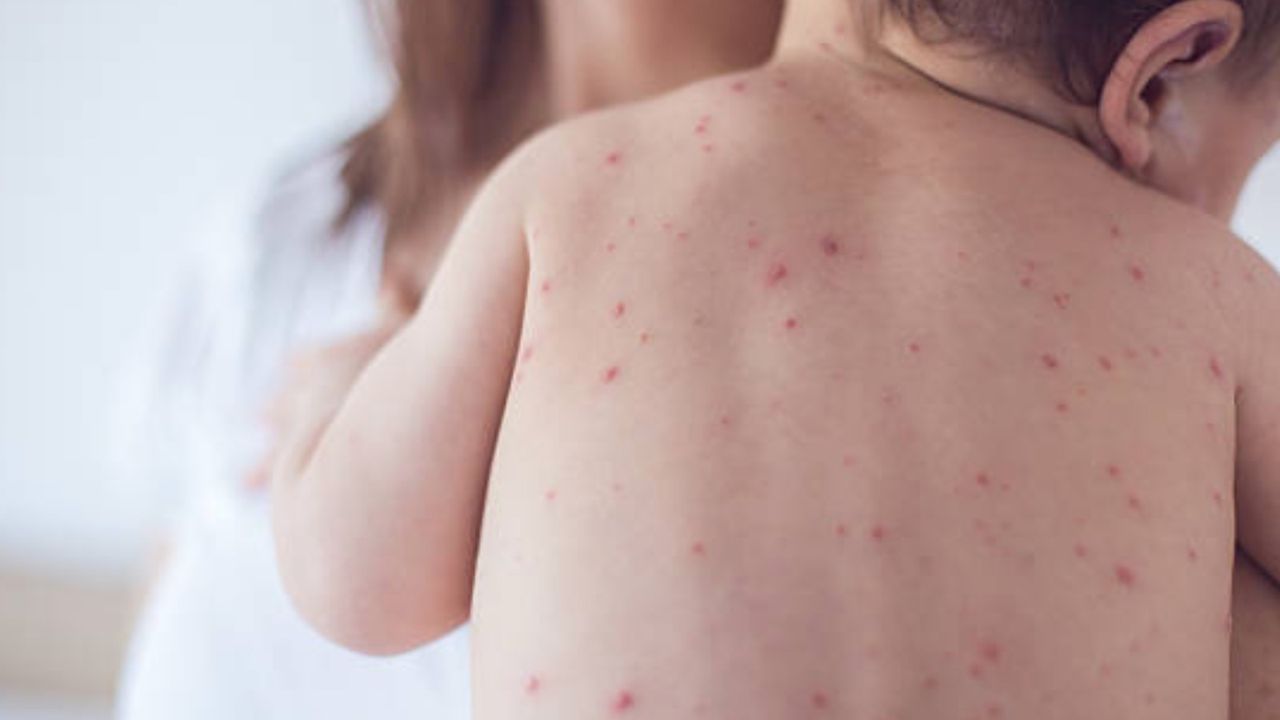 Bebeklerde ve çocuklarda besin alerjileri arttı!