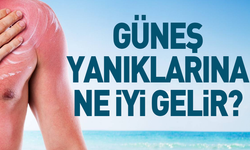 Güneş yanıklarına ne iyi gelir?