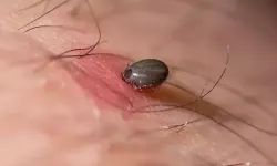 Kene ısırığı sonucu bir vatandaş hayatını kaybetti
