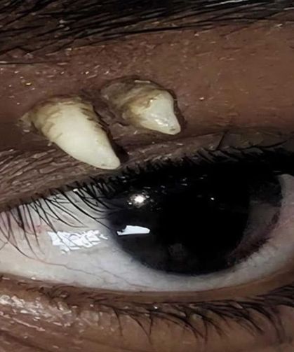Muayene eden doktorlar bile inanamadı: Çocuğun göz çukurundan köpek dişi tespit edildi!
