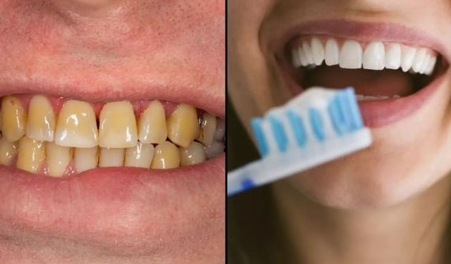 Dişlerinizi beyaz tutmak için bu üç hatadan kaçının