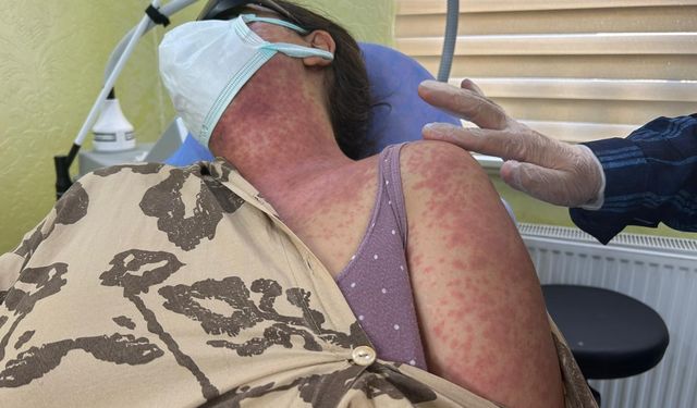 Van'da ‘beyazlatıcı krem' faciası: 4 kişi hastanelik oldu