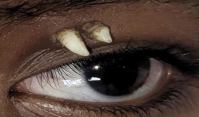 Muayene eden doktorlar bile inanamadı: Çocuğun göz çukurundan köpek dişi tespit edildi!